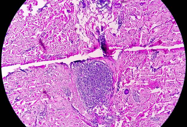 Chronic Endometritis: The Overlooked Cause of Repeated Implantation Failure