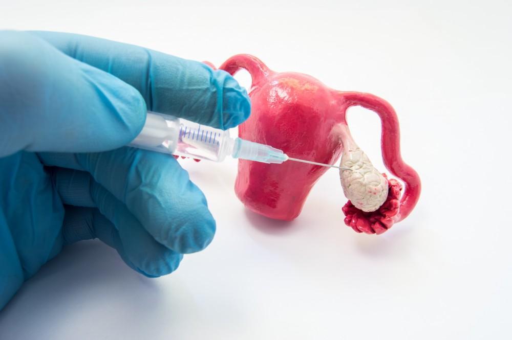 What Happens After Ovulation Induction?